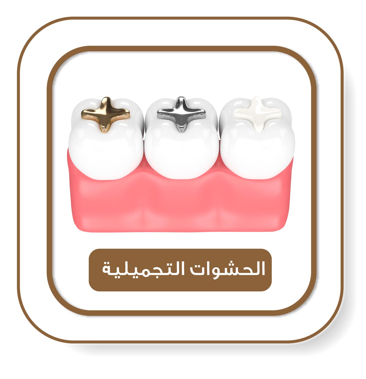 حشوات أسنان مختلفة داخل لثة صناعية – ذهبية، فضية، وبيضاء – توضح الخيارات المتاحة لعلاج التسوس.