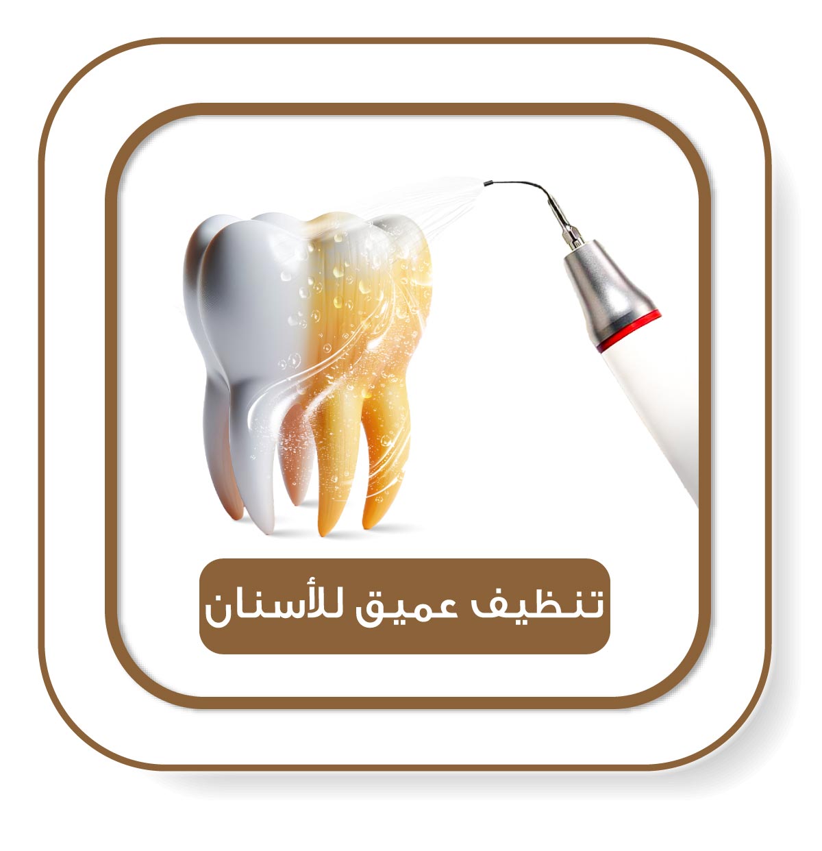 صورة توضيحية لسن يتم تنظيفه باستخدام جهاز الموجات فوق الصوتية، يُظهر إزالة الرواسب والاصفرار بطريقة دقيقة وفعالة.**
